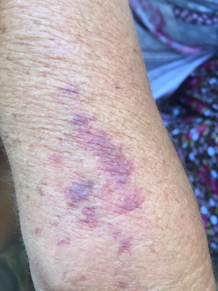 Kahverengi kokarcalar fındık toplarken ısırıyor 